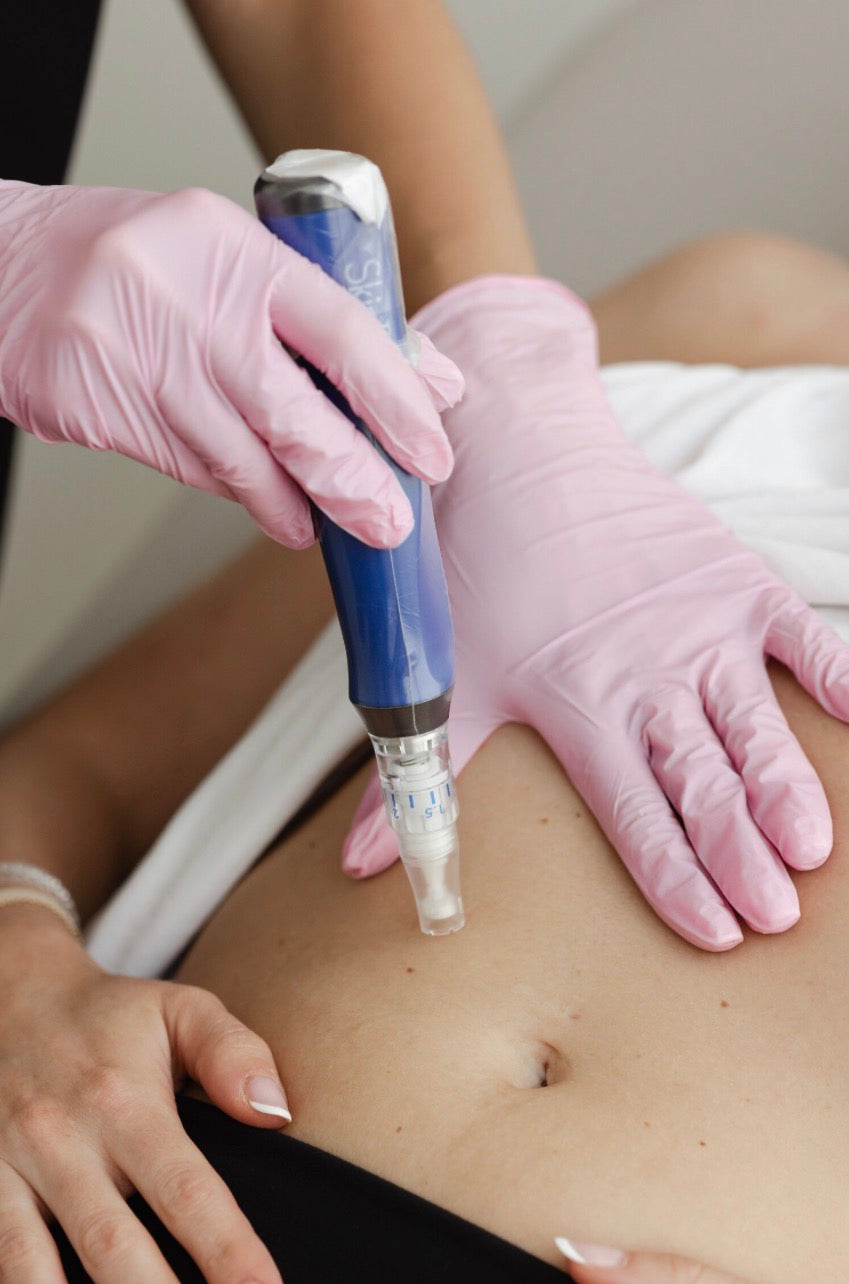 Microneedling - Body